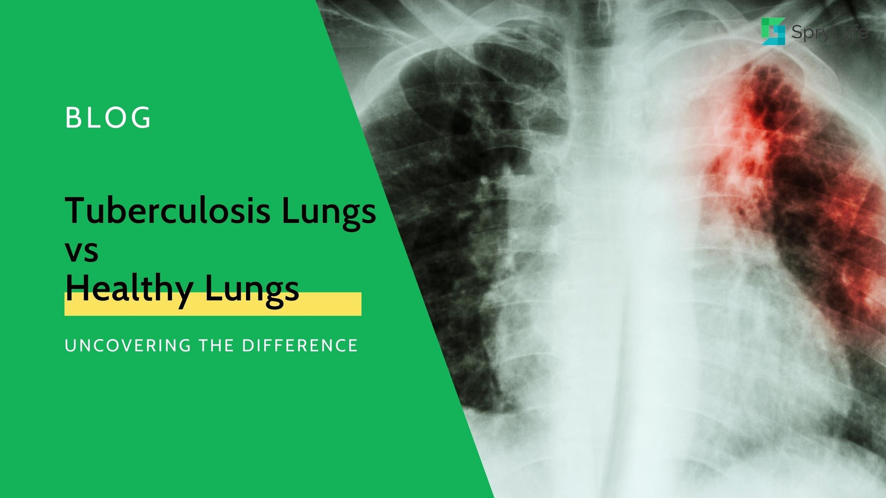 Tuberculosis Lungs vs Healthy Lungs: Uncovering the Difference